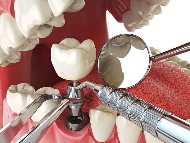 Best Emergency Dental Extractions in East Dundee, IL